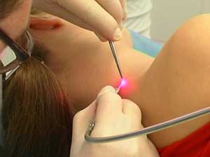 Лазерное удаление родинок