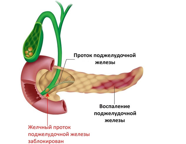 Лечение панкреатита у детей украина