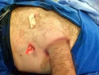 Хирурги сохранили пациенту руку, зашив ее в живот фото