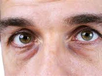 Как быстро избавиться от отеков под глазами фото