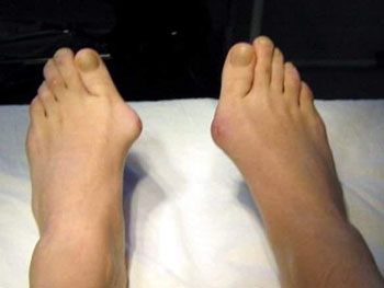 Медики рассказали, как правильно лечить «косточку» на ногах фото