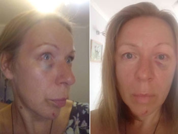 Избитая актером Сватов женщина рассказала о своем состоянии: опубликовано видео фото