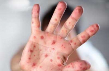 В Мелитополе корью заболели двое взрослых и двое детей фото