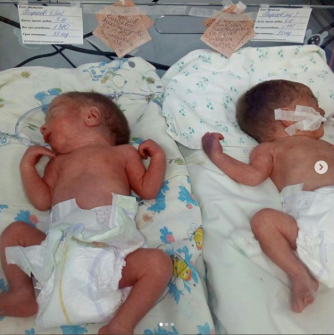 Двойняшки, которых 15-летняя запорожанка родила раньше срока, находятся в тяжелом состоянии фото