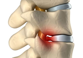 Лечение грыжи позвоночника фото