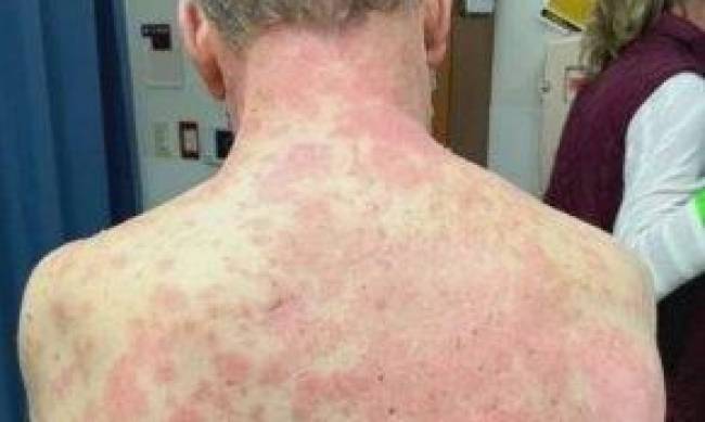 У мужчины после прививки от коронавируса начала слезать кожа: что сказали врачи фото