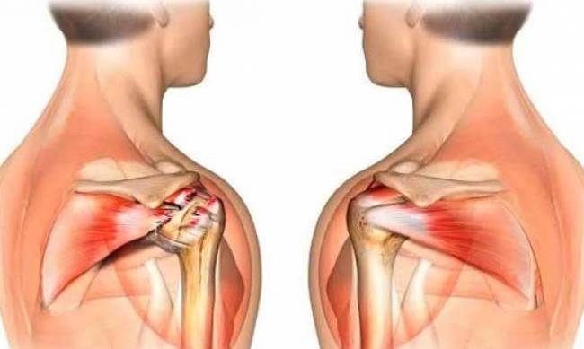  Как вылечить синдром Педжета Шреттера?  фото