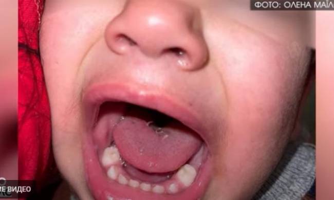 В Полтаве 2-летний ребенок пришел из детсада с порезанным языком фото