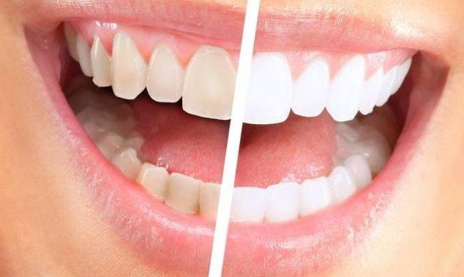 Експерти спростували п’ять найбільш популярних міфів про домашнє відбілювання зубів фото