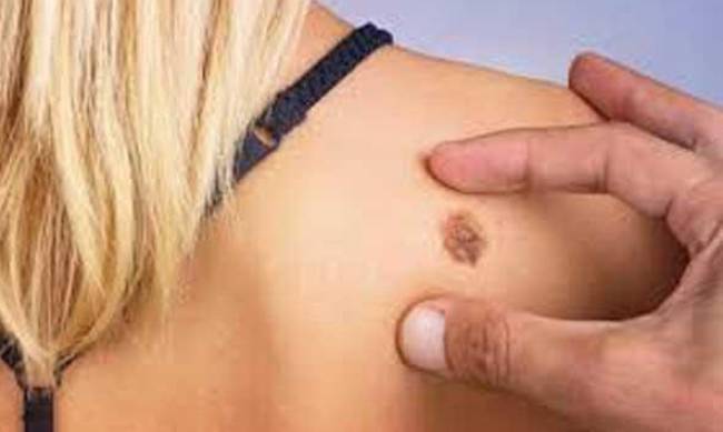 Рак шкіри - відповідаємо на поширенні питання фото